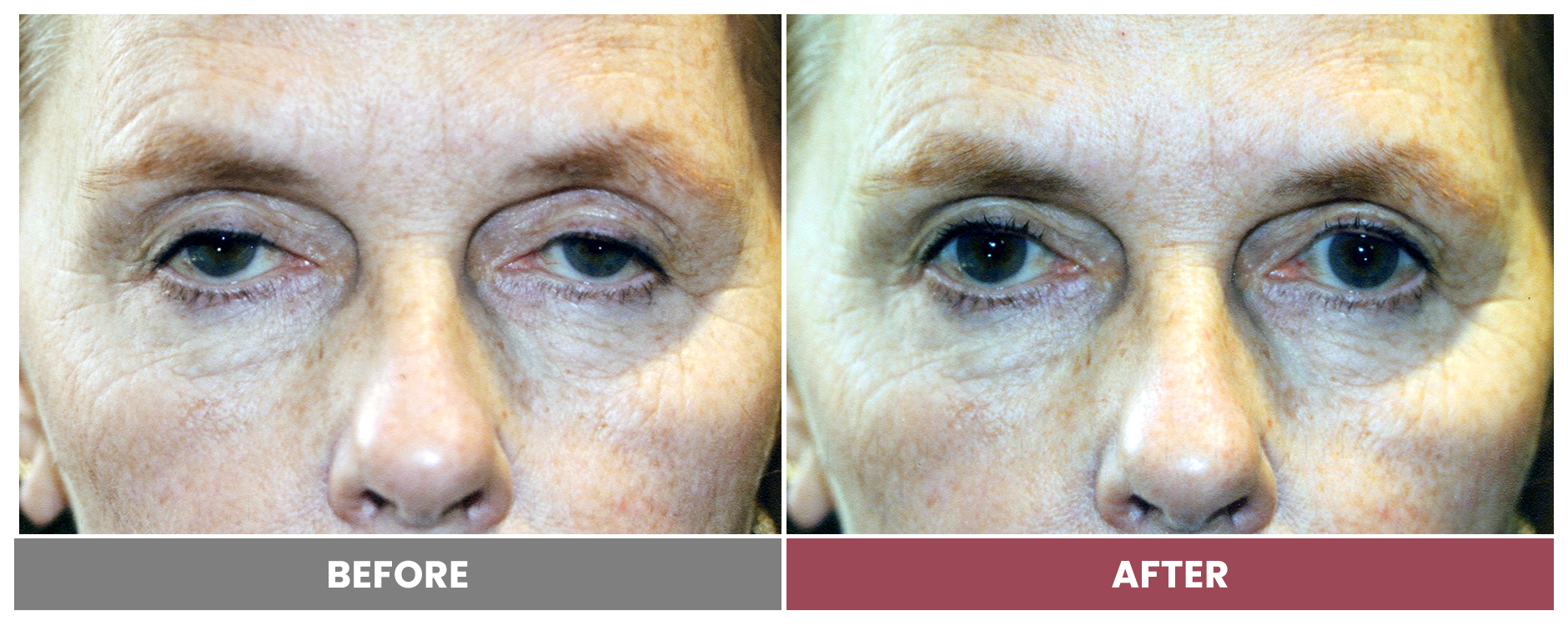 PTOSIS REPAIR - Case 43